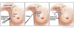 sentinel lymph node biopsy