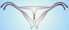 Septate uterus: defect, description, types, risks