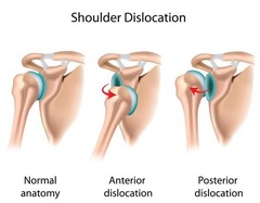 Shoulder dislocations