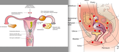 Side note - endometriosis