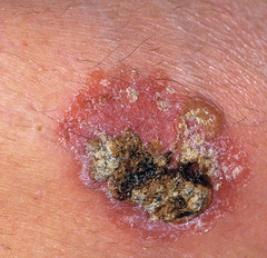 Squamous Cell Carcinoma in SITU (SCCIS/Bowens Disease)