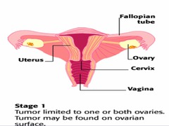Stage I ovarian cancer