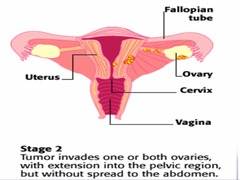 Stage II ovarian cancer