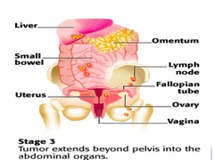 Stage III ovarian cancer