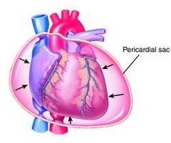 tamponade (cardiac)