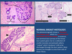 Terminal duct lobular unit