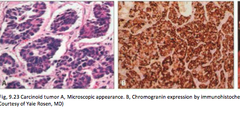 The cells in a carcinoid tumor will be positive for what markers (very high-yield)?