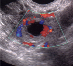 The corpus luteum cyst will create what kind of doppler image?