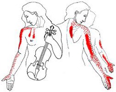 Thoracic outlet syndrome