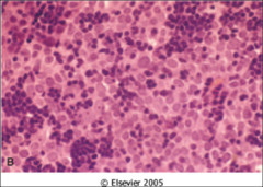 thymoma