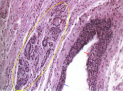 Thyroglossal duct cyst - histology