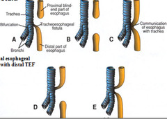 Tracheoesophageal Fistula/Esophageal Atresia