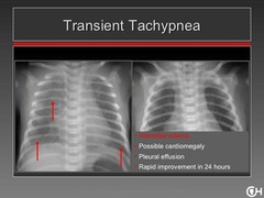 Transient Tachypnea of the Newborn