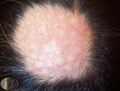 treatment for alopecia areata?