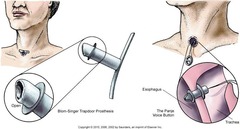 Two types of prosthesis used in a transesophageal puncture are