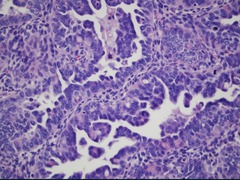 Type II endometrial carcinoma histology