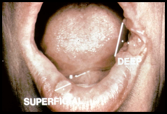 Ulcer depth is greater than 3mm
