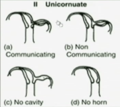 Unicornuate uterus: defect, description, complications, symptoms