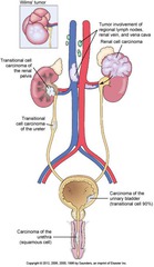 Urinary Tract Tumors (Cont'd)