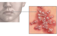 Viral infection causing blisters on skin of lips, nose, or genitals: a. Kaposi sarcoma b. Herpes simplex c. Cryptococcus d. Toxoplasmosis e. Pneumocystis carinii pneumonia