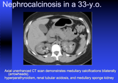 what are 3 cases of nephrocalcinosis?  what's the most common?