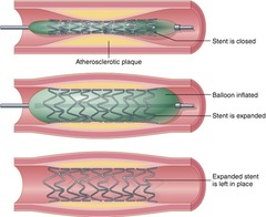 What are angioplasty and vascular stenting?