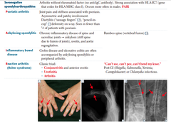 What are Spondyloarthropathies?