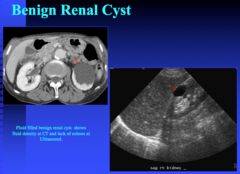 what are the 3 criteria for diagnosing a simple cyst on US?  what does a cyst look like on post contrast CT?