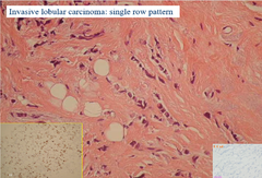 What are the characteristics of Lobular carcinoma on histology?