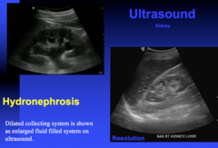 what are the limitations of using US to see obstruction causing hydronephrosis?