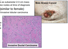 What are the tumor types and characteristics of breast cancer in men?