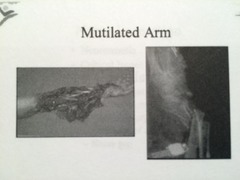 What do you do with this mutilated arm?