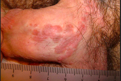 What does Bowens disease look like?