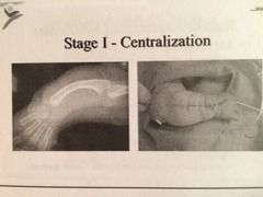 What does wrist centralization look like?  What is the thumb surgery for type I through V thumb hypoplasia?,