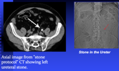 what is a feature of hydronephrosis on CT?  what's stone protocol