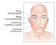 What is a pan coast tumor?