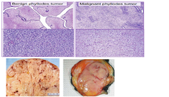 What is a phyllodes tumor?