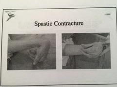 What is a reasonable approach to a spastic contracture?