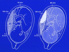 What is Abruptio Placenta?