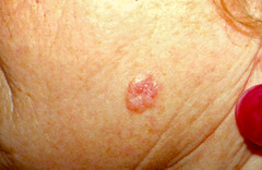 What is Basal Cell Carcinoma?