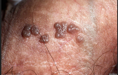 What is bowenoid papulosis? How to treat?  (HINT: this is not quite the same as Bowens disease)