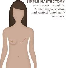 What is Mastectomy