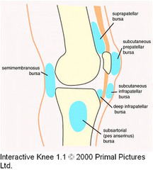 What is prepatellar bursitis?