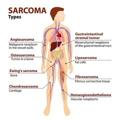 What is sarcoma?