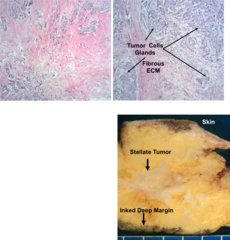 What is the appearance of ductal carcinoma on histology?