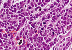 What is the characteristic histology of small cell carcinoma?