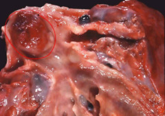 What is the classic tumor seen with a carcinoid tumor (very high-yield)?