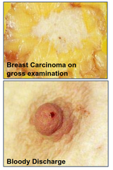 What is the clinical presentation of Invasive carcinoma of the breast?