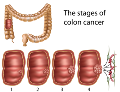 What is the purpose of staging cancer?