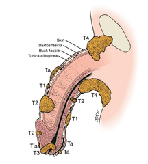 What is the T-staging of penile cancer?